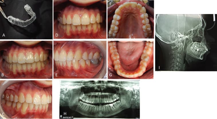 Published post-treatment intraoral photographs and radiographs after clear aligner therapy