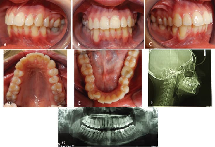 Published pretreatment intraoral photographs and radiographs showing moderate crowding