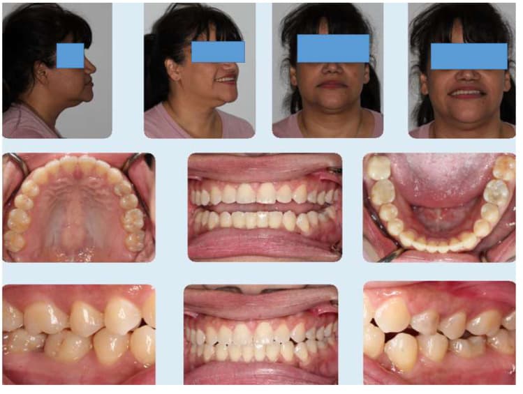 Published final facial and intraoral photographs after clear aligner treatment