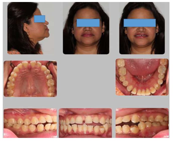 Published pretreatment facial and intraoral photographs showing an anterior open bite and spacing