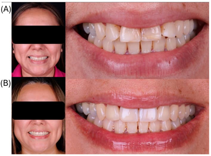 Published clinical comparison showing the smile and anterior teeth before and after four lithium disilicate veneers